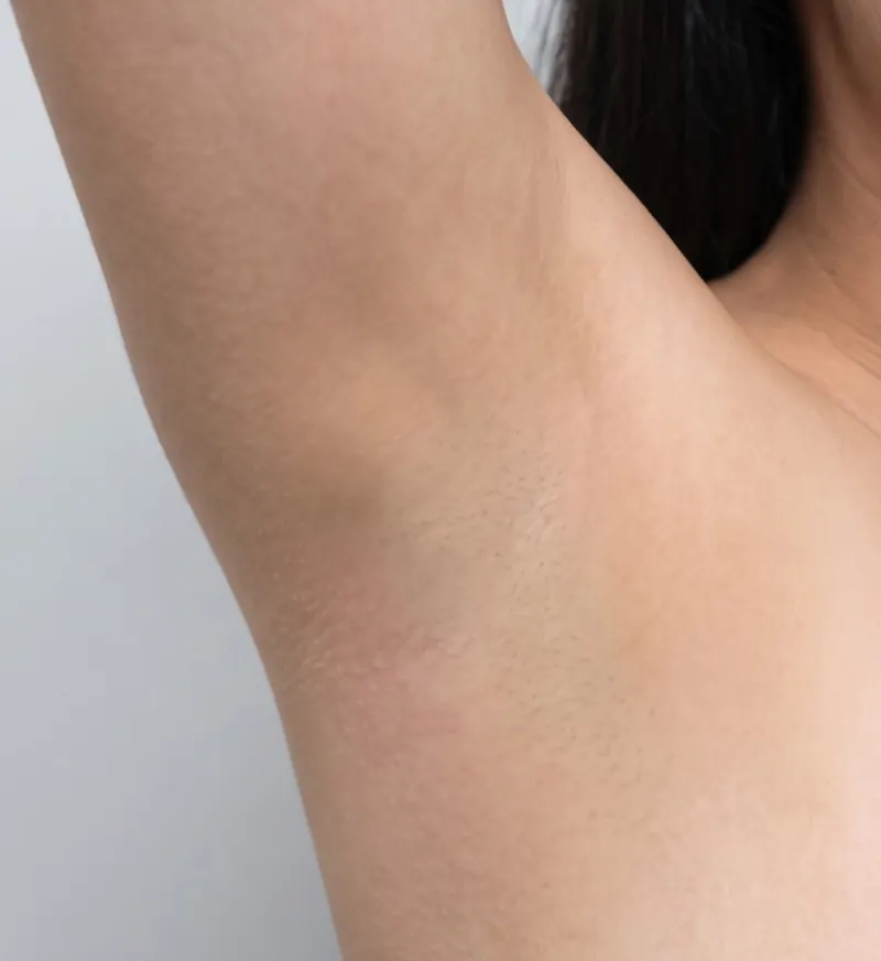 After — Laser hair removal — underarm before and after a 6-session course